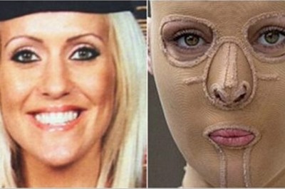 5 lat po ataku żrącą substancją zdecydowała się zdjąć maskę i pokazać światu swoją twarz