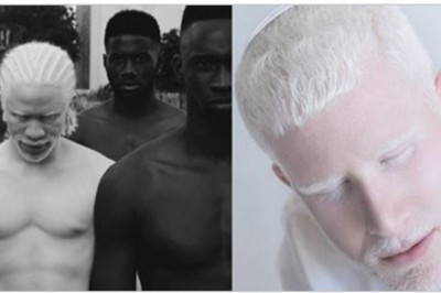 17 zdjęć ludzi cierpiących na albinizm! Wyglądają jak duchy, aż ciężko uwierzyć, że to nie photoshop!