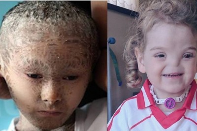 Z powodu swoich rzadkich chorób są znane na całym świecie! Wyjątkowe dzieci udowadniają, że warto walczyć!