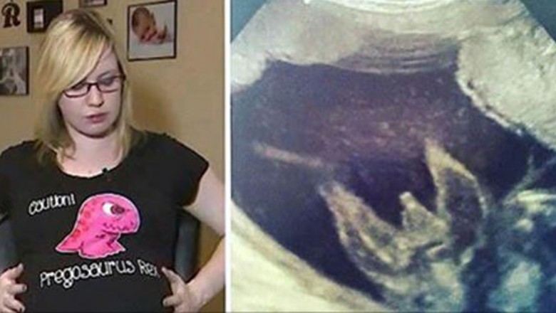Rodzice spodziewali się zwykłej ciąży! Po badaniu USG nie byli w stanie uwierzyć w słowa lekarza! 