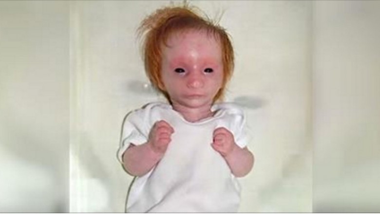 Jak się urodziła wyglądała jak porcelanowa lalka! Po 5 latach lekarze są zaskoczeni jak się zmienia!