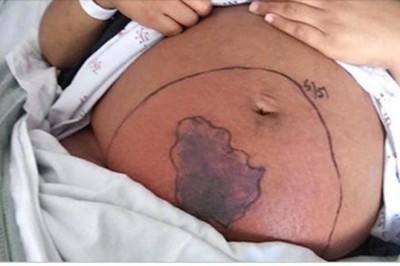 Ciężarną obudziła się z okropny bólem brzucha! Gdy spojrzała w dół, zauważyła, że chodzi po niej pająk!