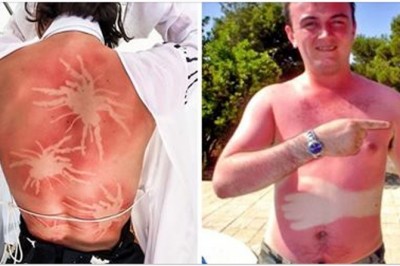 Te zdjęcia przypominają, że nie warto zasypiać na słońcu! Poparzenia słoneczne mogą wyglądać śmiesznie ale są niebezpieczne! 