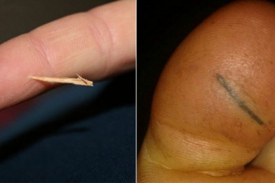 Mama musiała wyciągnąć drzazgę z palca płaczącej córeczki! Jej pomysł jak zrobić to bezboleśnie jest genialny!