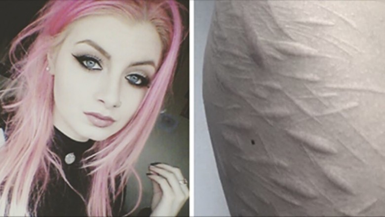 Żaden tatuażysta nie chciał zakryć blizn szpecących ciało tej 19-latki! Poza tym jednym!