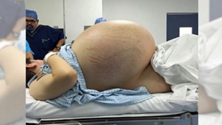 Wyglądała jak w ciąży z 5-raczkami! Jak lekarze prześwietlili jej brzuch nie mogli uwierzyć co znaleźli!