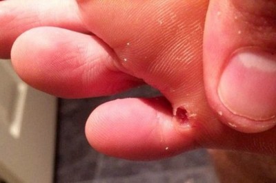 Jeśli zauważasz u siebie te objawy, to prawdopodobnie w twoim organizmie zagnieździły się pasożyty!