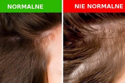 5 rzeczy, które twoje włosy mogą zdradzić na temat twojego zdrowia. Zobacz jakie objawy są niepokojące