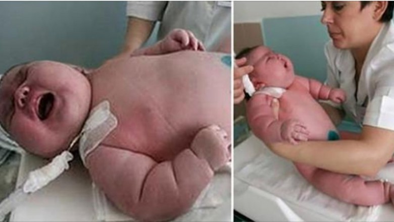Ważąca 270 kg kobieta trafia w nocy do szpitala na porodówkę. Rodzi synka, którego waga to niemal 18 kg 