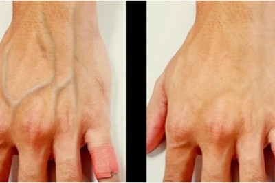 Dlaczego u niektórych osób żyły są mocno widoczne pod skórą? Dowiedz się co to może oznaczać