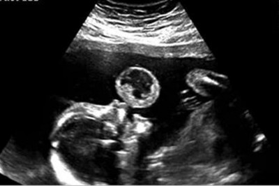 Mama myśli, że na USG widać jak jej maluch puszcza bańki. Wtedy lekarz przekazuję jej złe nowiny