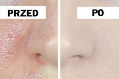 Masz problem z otwartymi porami na swojej cerze? 3 dniowa terapia pozwoli Ci się ich pozbyć