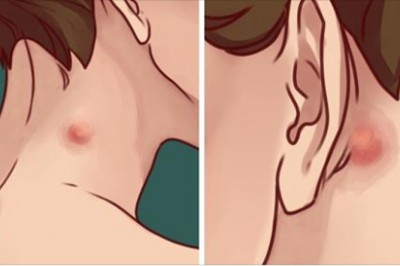 Oto czy masz powody do niepokoju jeśli zauważyłaś guzek na szyi lub za uchem