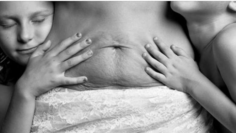 Fotograf pokazuje prawdziwe oblicze kobiecego ciała po przebytej ciąży. Tego nie zobaczysz w żadnym magazynie mody