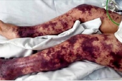 Ciało 7-letniej dziewczynki zaczynają pokrywać siniaki. Gdy mama orientuje się, co się dzieje jest już za późno