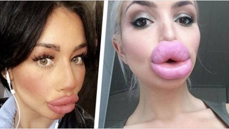 25 kobiet które zdecydowanie przesadziły powiększając sobie usta. Dlaczego nikt im nie powiedział stop