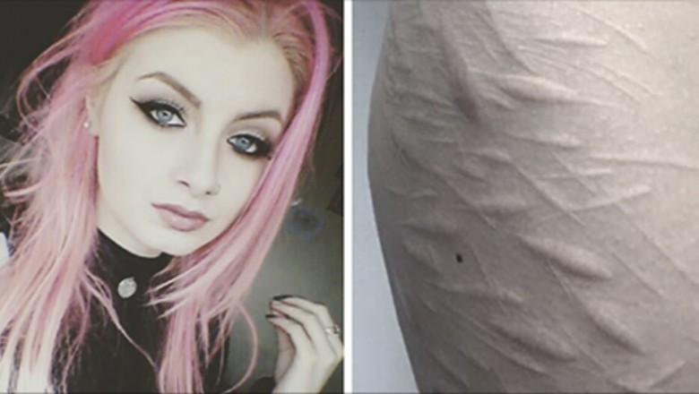Żaden tatuażysta nie chciał zakryć blizn na ciele tej 19-latki. Poza tym jednym