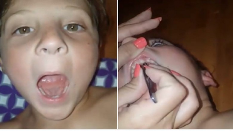 Syn skarżył się na bóle dziąseł. W jego ustach mama znalazła wrośnięte 32 paznokcie