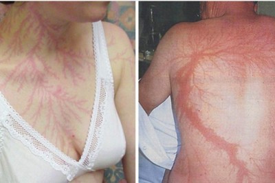 Ci ludzie przeżyli bezpośrednie uderzenie pioruna. Na ich skórze pozostały niesamowite ślady