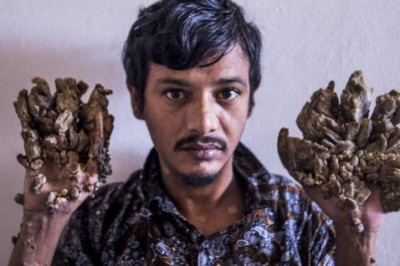 „Człowiek drzewo” ma wstrząsającą prośbę do lekarzy. Nie jest wstanie wytrzymać już bólu 