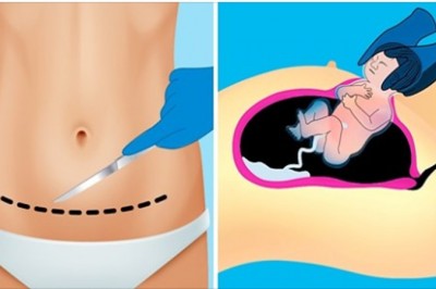 10 sposobów na szybsze dojście do siebie po cięciu cesarskim