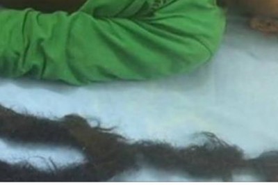 Miał ostre bóle brzucha i musiał być operowany. Po 3 godzinach wyciągnęli z niego żerującego brata bliźniaka