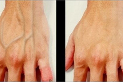 Dlaczego u niektórych osób żyły są mocno widoczne pod skórą? Zobacz co to może oznaczać