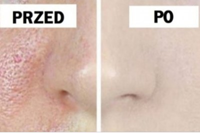 Masz problem z otwartymi porami na swojej cerze? 3 dniowa terapia pomoże Ci się ich pozbyć