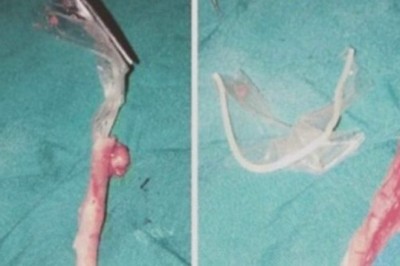 Strasznie bolał ją brzuch. Jak lekarze otworzyli jej jelito nie wierzyli własnym oczom