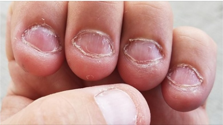8 porad, które pomogą ci zerwać z nałogiem obgryzania paznokci