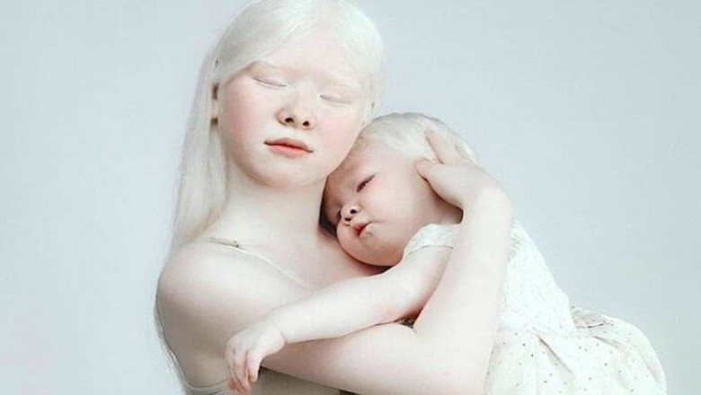 Niezwykłe siostry z albinizmem oczarowały cały świat swoimi zdjęciami. Wyglądają magicznie 