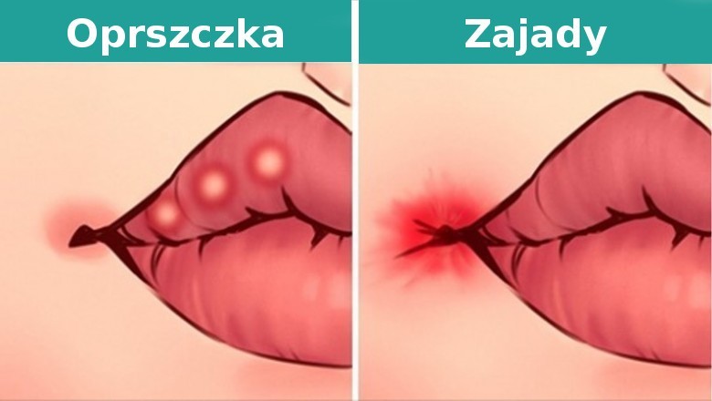 8 rzeczy, jakie stan twoich ust może powiedzieć na temat twojego zdrowia