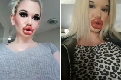 Chce wyglądać jak „żywa Barbie”. Ta 23-latka ma największe usta na świecie