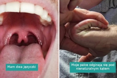 15 przypadków, gdy natura postanowiła zagrać na genetycznej loterii