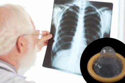 Przez 6 miesięcy zmagała się z kaszlem i gorączką. Lekarze odkryli nietypowe ciało obce w drogach oddechowych